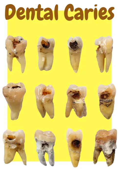 Dental Caries