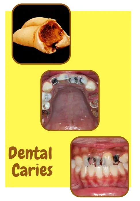 Dental Caries