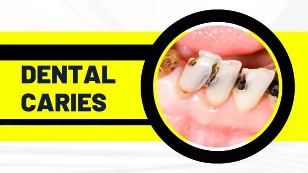 Dental Caries: What are the Causes and How to Prevent – Learn within 15 Minutes