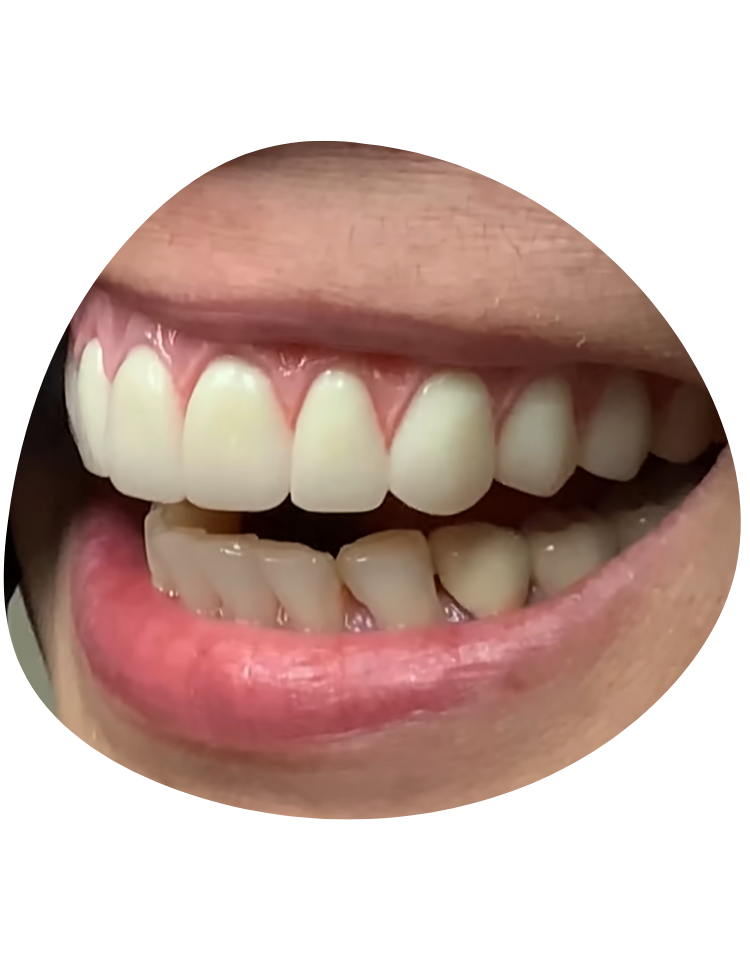 Conventional Denture