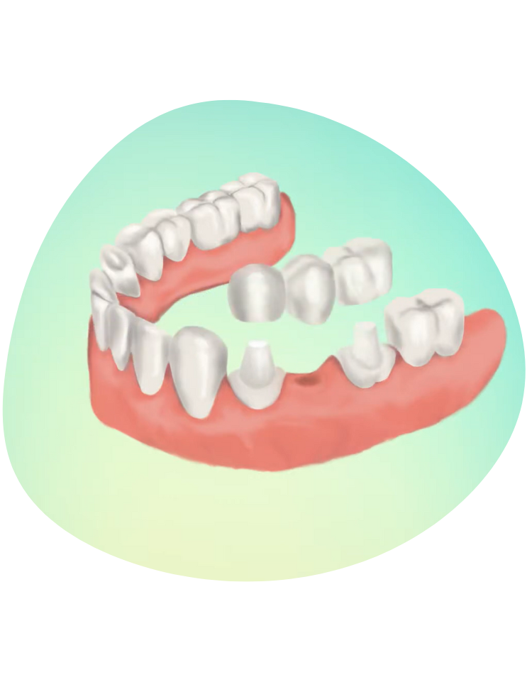 Dental Bridge