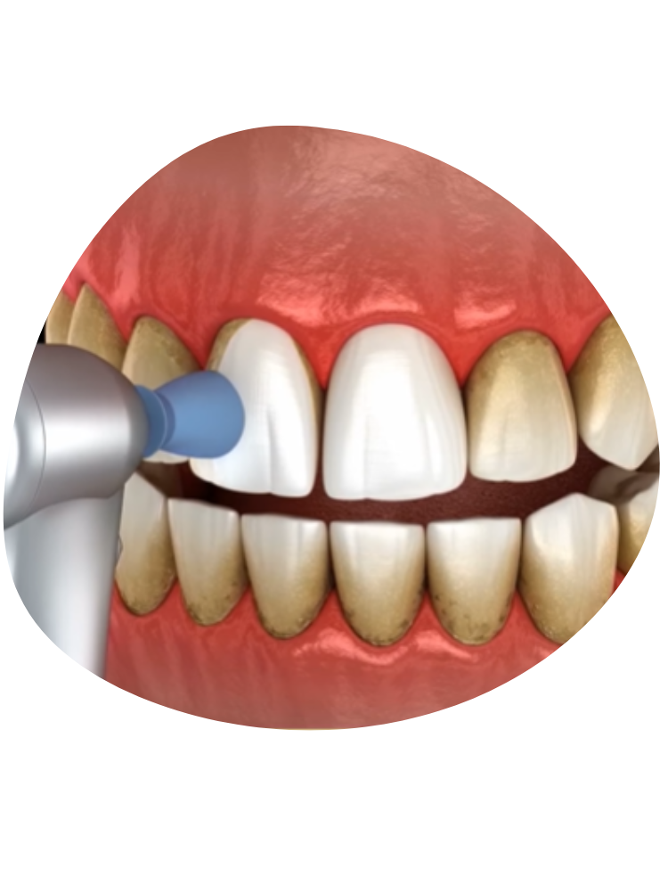 Dental Polishing