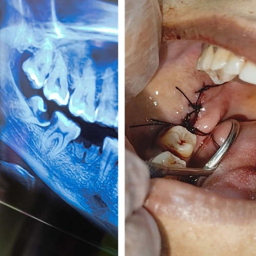 3rd Molar Extraction