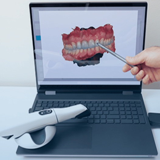 Intraoral Scaning for Implant