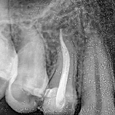 RCT of Anterior tooth With Builtup