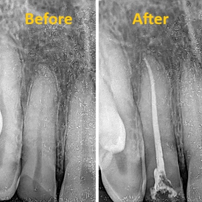 RCT of Anterior Tooth Without Builtup