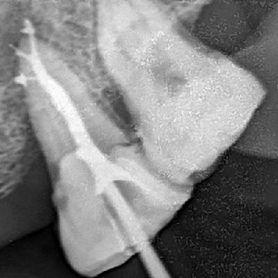RCT of Posterior tooth With Builtup