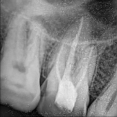RCT of Posterior tooth Without Builtup