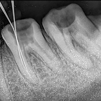 Re-RCT of Posterior Tooth