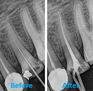 Re-RCT of Anterior Tooth