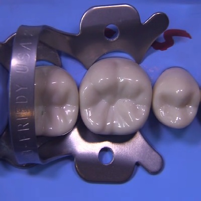 Rubber Dam Application
