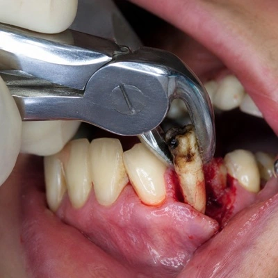 Tooth Extraction