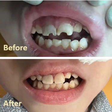 Anterior Strip Crown