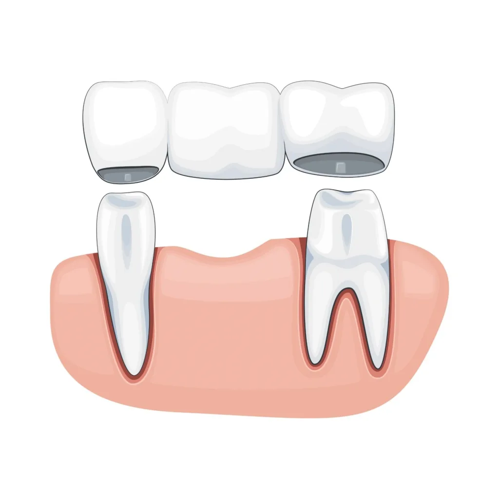 Dental Bridge